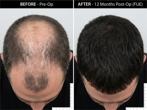 LP Transplante Capilar.jpg2